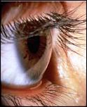 boli ochilor.....keratoconul-kera_ochi-jpg