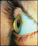 boli ochilor.....keratoconul-keratocon-jpg