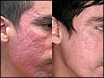 how-to-fade-acne-scars-1024x768.jpg